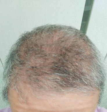 脱发治疗实例