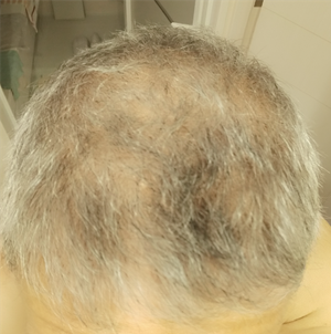脱发治疗实例